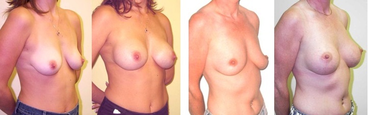 four examples of a successfully completed boob job in Birmingham