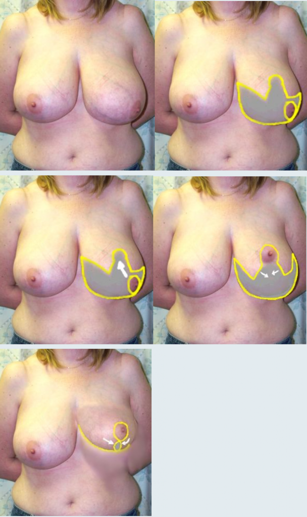 descriptive image of the process involved within breast reduction surgeries by Guy Sterne