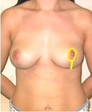 front image of how breast uplift procedures are carried out via the nipple. From Guy Sterne Birmingham