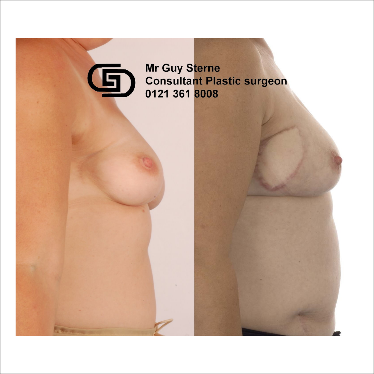 Mini-ELD for Breast Deformity